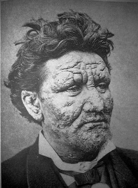 5 real diseases that could make you act just like a zombie