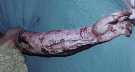 5 real diseases that could make you act just like a zombie